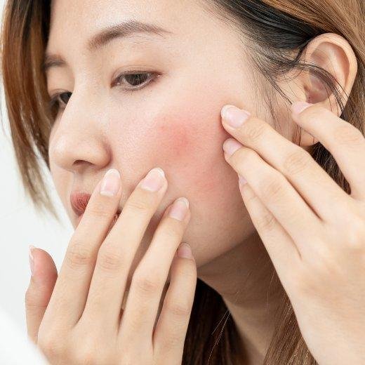 Skin rosacea