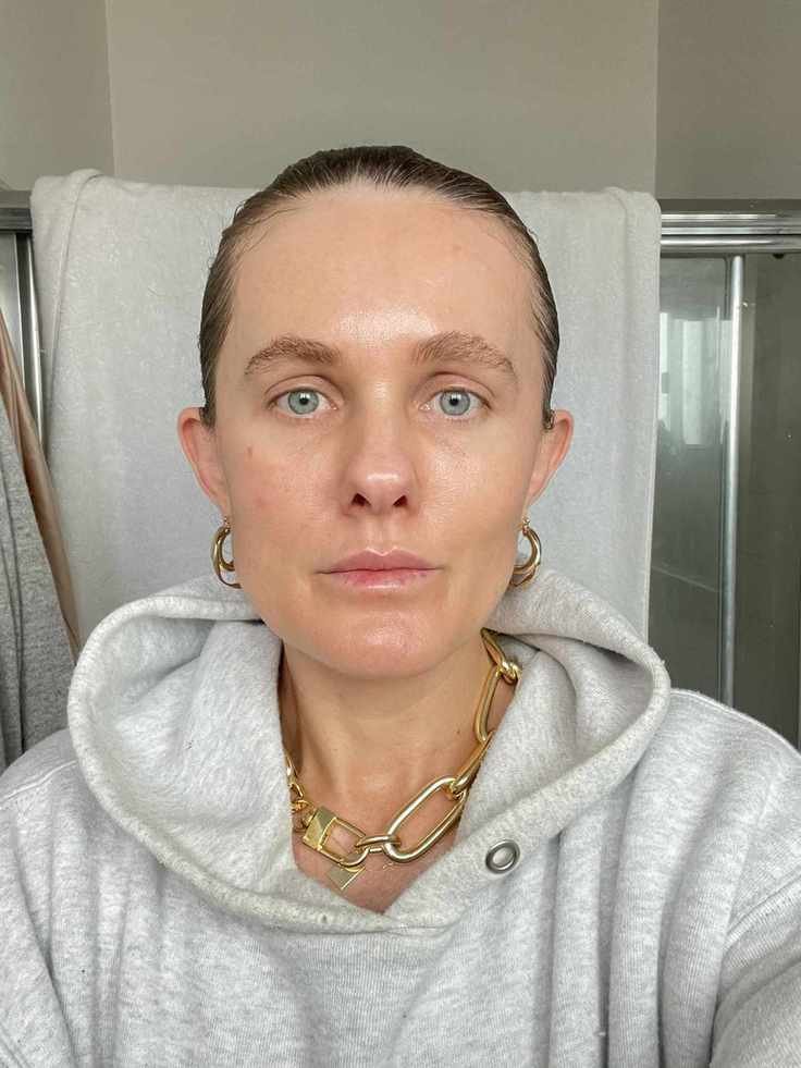Microneedling with PRP: A Transformative Experience for Your Skin