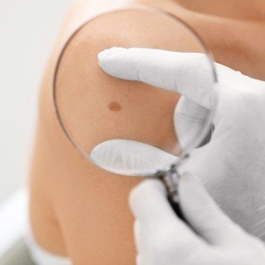 Assessing Your Melanoma Risk: Key Factors and Essential Steps