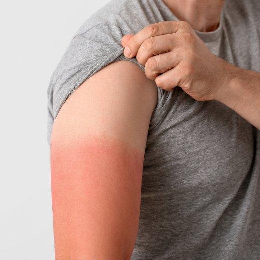 Sunburn Relief: Essential Steps for Healing Your Skin