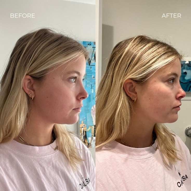 depuffing chin strap