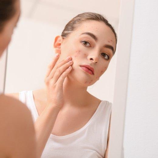 Managing Adult Acne: 7 Essential Tips for Clearer Skin