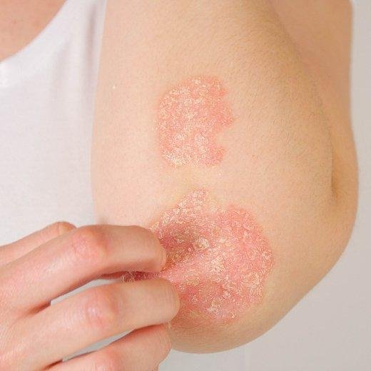 Effective Skin Care Tips to Manage Psoriasis Itch