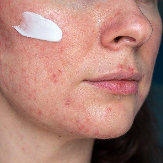 Understanding Rosacea: Key Triggers and Their Management