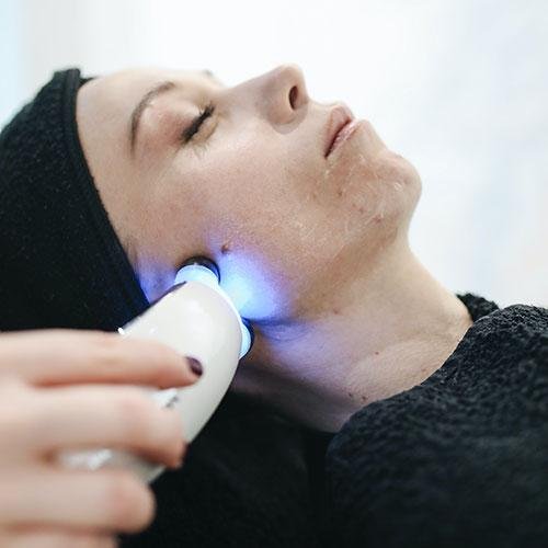 Top Five Methods to Eliminate Acne Scars Effectively