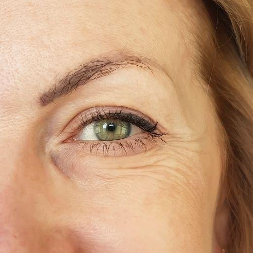 Understanding Crow's Feet and Effective Ways to Address Them