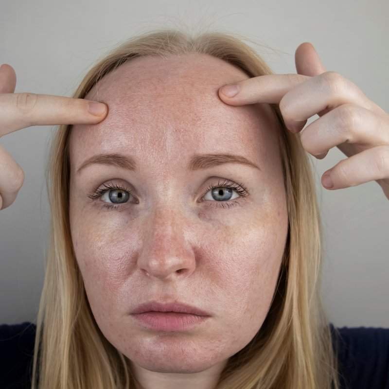 Essential Skin Care Routine for Oily Skin Types