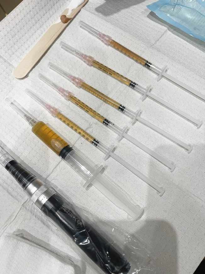 microneedling and prp
