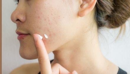 ACNE on face