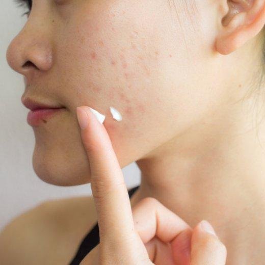 Understanding the Link Between Adult Acne and Aging