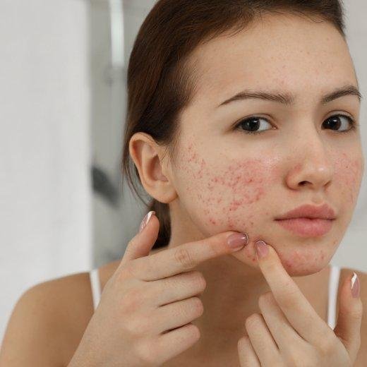 Skin Care for Teens: Supporting Your Child's Acne Journey