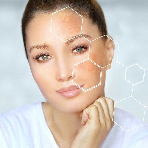 Skin Care Strategies for Managing Rosacea Effectively