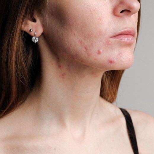 Managing Post-Pill Acne: Tips After Stopping Birth Control